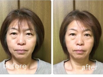 アップル マリー 江別/■小顔矯正