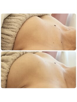 アンドモア(&more)/バストアップ症例