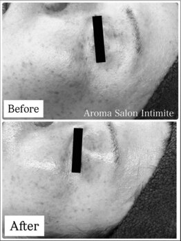 アンティミテ(Intimite)/パーソナルスキンケアコース