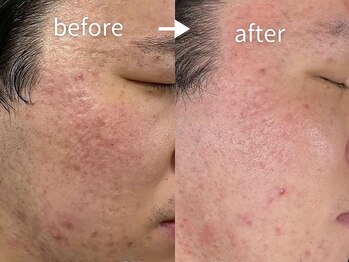 アルカンシエル(arcenciel)/凹凸肌改善プロセルセラピーズ