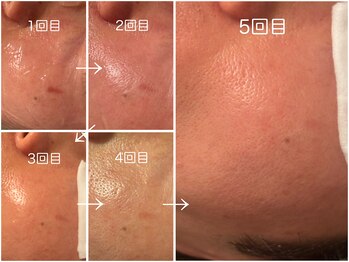 にっこりビューティー/★美顔光フォト