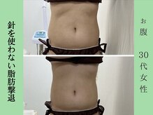 ソルニス(Solnis.)/痩身☆脂肪分解/ハイパーナイフ