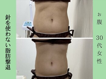 ソルニス(Solnis.)/痩身☆脂肪分解/ハイパーナイフ