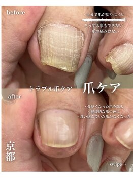 アイル(isle)/【爪が切れない！86歳のお客様】