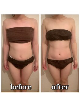 シェノン(CHAINON)/キャビテーション