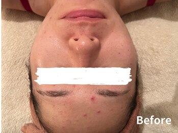 ダイヤモンド リーエンダ(Diamond leende)/クレイハーブピーリング