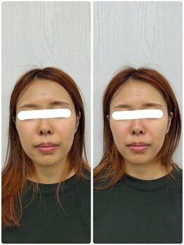 ラフテル鍼灸整骨院/小顔矯正でお顔の左右差改善♪