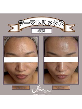 ビーマジック(美magic)/サーマトリックス