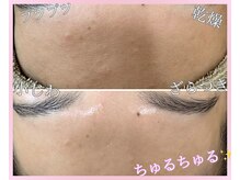 ルリエベル(Relier Belle)/ざらつきにはハーブピーリング♪