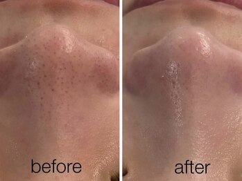 リスポアラボ(LIS PORE.LAB)/1回BeforeAfter