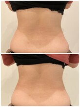 ルナート(Lunart)/腸もみの一回の変化