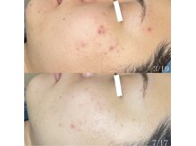 ちらちゅら/クリスティーナ【施術6回】