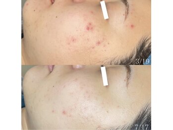 ちらちゅら/クリスティーナ【施術6回】