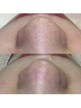 ビオルブ(VIOLVE)/黒ずみが気になる方へ！毛穴ケア