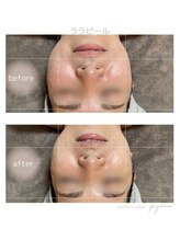 ピョル(pyoru)/ララピール1回施術にて