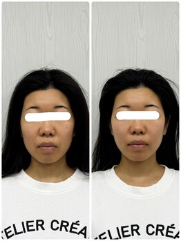 ラフテル鍼灸整骨院/美容鍼で口角・頬骨が上がる！