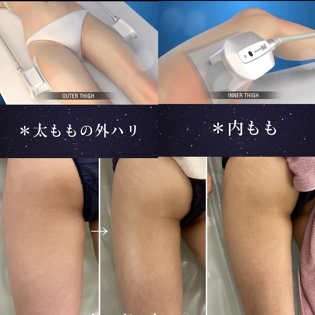 【痩身】イベント前に時短で効果実感◎ 専門メソッドで速攻スリムボディ