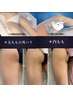 【痩身】脂肪冷却＋セルゼロのコラボで狙った脂肪を徹底的に強力アプローチ！