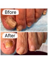 フットファースト 名古屋池下店/高齢者の分厚い爪も綺麗に◎