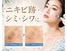 【過去のニキビ/凹凸肌へ】贅沢なめらかケア!エステダーマ×ハーブピーリング