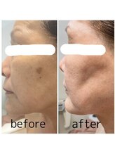 グレイスボディ ヨークタウン坂東店(Grace Body)/光フェイシャルビフォーアフター