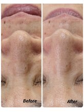 ラヴィアンローズ 蒲郡店(& La vie en Rose)/毛穴ケア