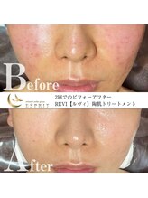 エスプリ 銀座店/ハーブピーリング銀座