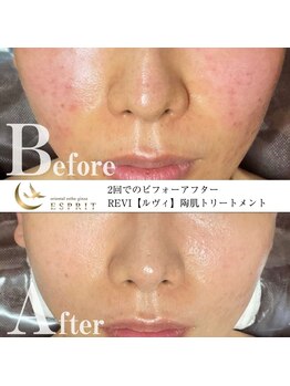 エスプリ 銀座店/ハーブピーリング銀座