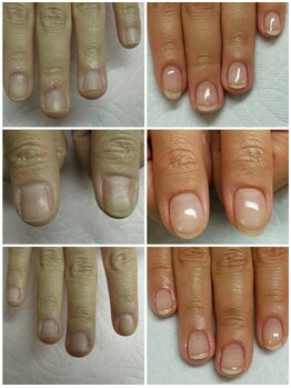 コットンローズ(Cotton Rose)/深爪ケア