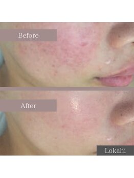 ロカヒ(Lokahi)/#水光肌ピール#赤み肌も透明感UP