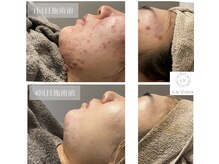 ラヴィオーラ 天王寺(La Viora)/ダイヤモンドハーブピーリング