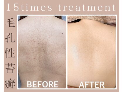 ハーブピーリング 恵比寿の写真