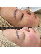 アネモネ(ANEMONE)/核酸DNAフェイシャル