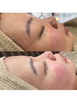 アネモネ(ANEMONE)/核酸DNAフェイシャル