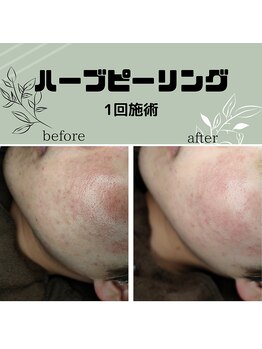 とびきりエステ 沼津店/Before→ After