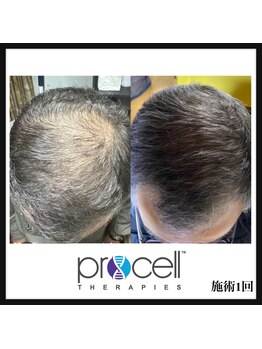 ヒルナム(Heal Nam)/プロセルセラピーズ　~頭皮~