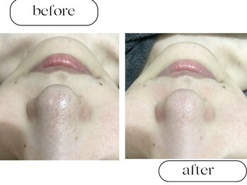 ルボン(RUBON)/毛穴の黒ずみ角栓