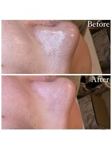 マドモアゼル 麻布十番/毛穴洗浄