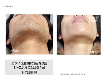 フェレザ 新潟(Felleza)/ヒゲ脱毛で毎朝が快適!