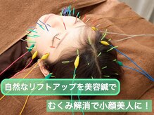 スプリング鍼灸院(Spring鍼灸院)/30代女性 美容鍼！