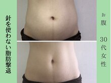 ソルニス(Solnis.)/痩身☆脂肪分解/ハイパーナイフ