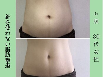 ソルニス(Solnis.)/痩身☆脂肪分解/ハイパーナイフ