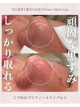 レア(Lea)/頑固な黒ずみもしっかり取れる＊