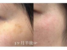 サロンドオール(Salon de Or.)の雰囲気（“Nuare”で顔の小さなシミ～大きなシミまで施術が可能！）