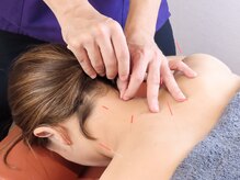 東武練馬鍼灸整体院シマ(shima)/鍼施術風景2