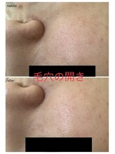 エスティ 京都店/毛穴の開きbefore/after