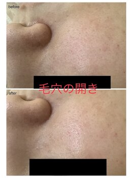 エスティ 京都店/毛穴の開きbefore/after