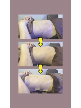 アムスパ(Aum Spa)/お腹周り脂肪分解液導入3回目