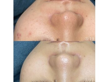 ちらちゅら/クリスティーナ【施術経過】