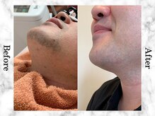 アンフルール(Une fleur)/脱毛 Before&After